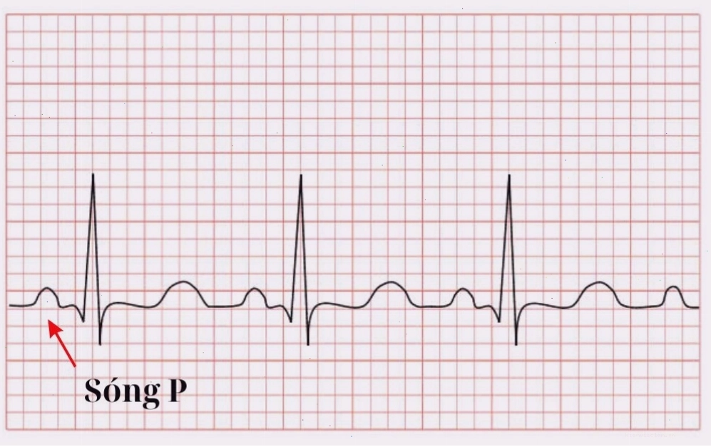 Hình dạng của sóng P trên điện tâm đồ