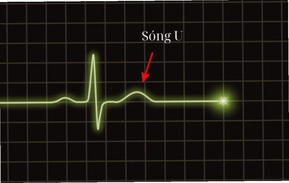 Hình dạng của sóng U trên điện tâm đồ