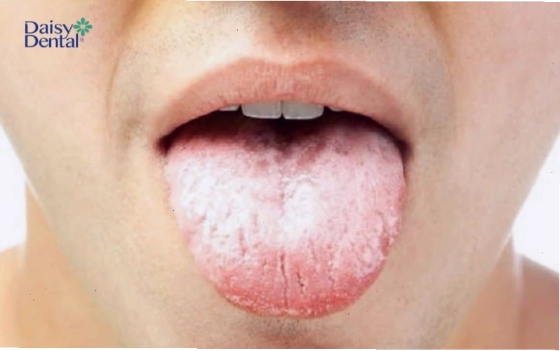 Khi lưỡi xuất hiện nhiều đốm trắng là dấu hiệu của bệnh nhiễm nấm Candida hay tưa miệng
