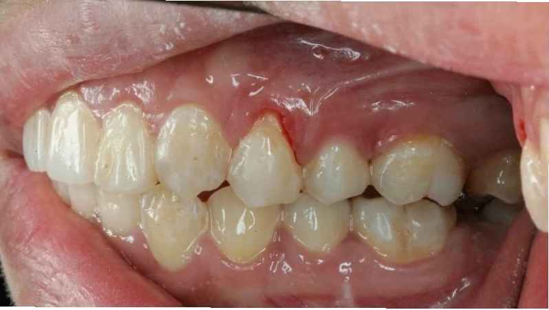 Khoảng trống giữa các răng sau khi lấy cao răng