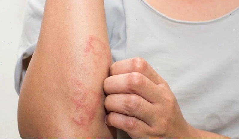 Kiến ba khoang cắn: Dấu hiệu nhận biết và cách xử trí nhanh chóng 2