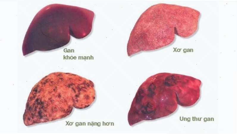 Lạm dụng bia rượu gây bệnh gan