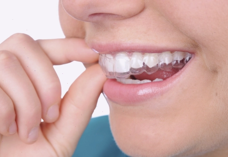 Làm trắng răng sau 1 đêm với máng tẩy trắng răng