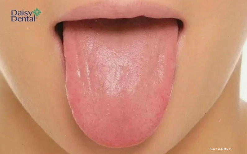 Lưỡi của người khỏe mạnh sẽ có màu hồng nhạt và ẩm ướt