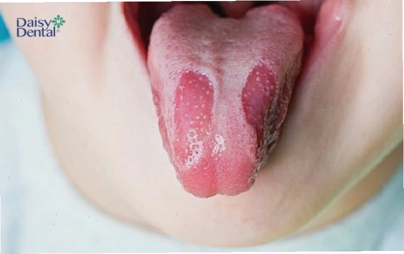 Lưỡi xuất hiện nhiều đốm trắng bất thường có thể là dấu hiệu của bệnh nấm Candida