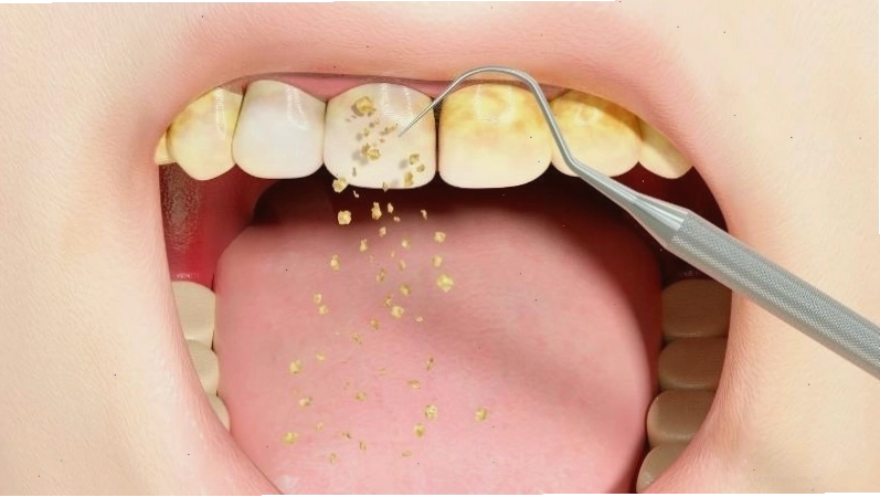 Men răng bị ảnh hưởng sau khi lấy cao răng không đúng kỹ thuật