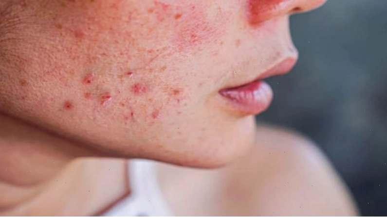 Mụn trứng cá có thể xuất hiện do thay đổi nội tiết tố khi mang thai