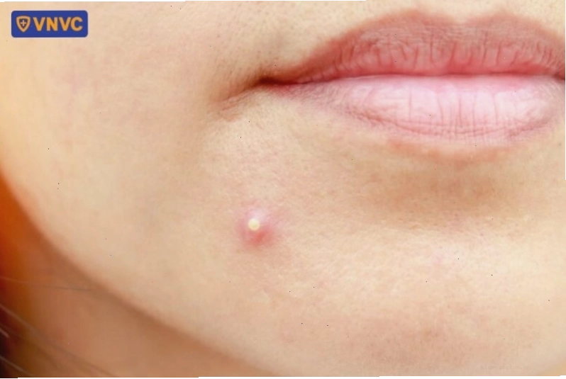 Mụn trứng cá với các loại khác nhau