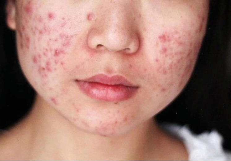 Ngủ muộn gây nổi mụn trứng cá
