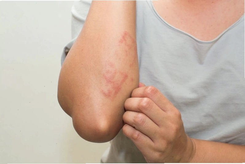 Người bệnh sốt mò có thể nổi ban đỏ ở nhiều vị trí trên cơ thể