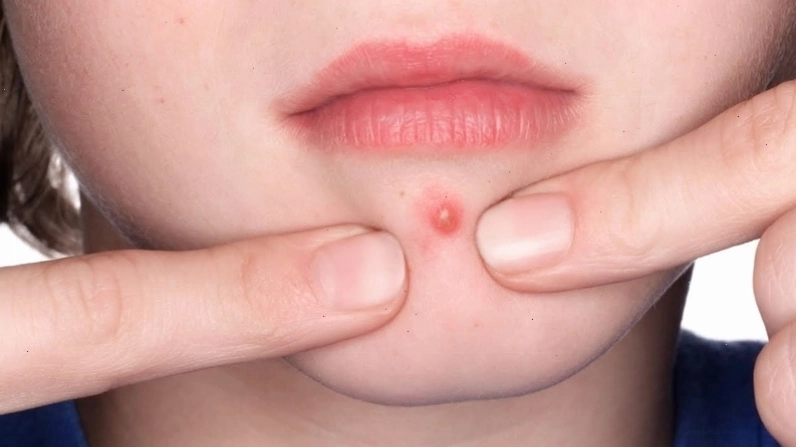 Nhựa cây đu đủ xanh chữa mụn đầu đinh