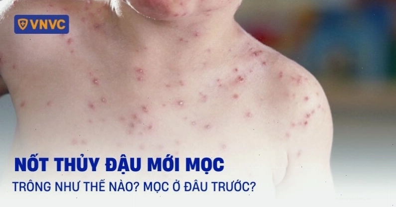 Nốt thủy đậu mới mọc với đặc trưng là mụn nước trong