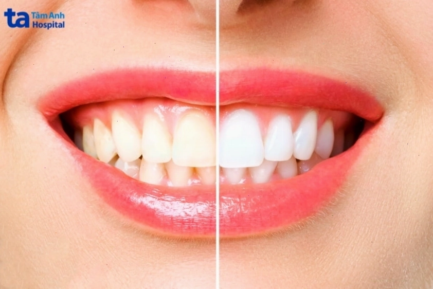 Nướu bị kích ứng đỏ và đau rát do tiếp xúc với thuốc tẩy trắng răng