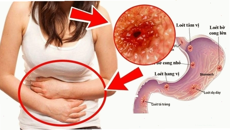 Ống nội soi dạ dày giúp bác sĩ phát hiện tổn thương đường tiêu hóa trên