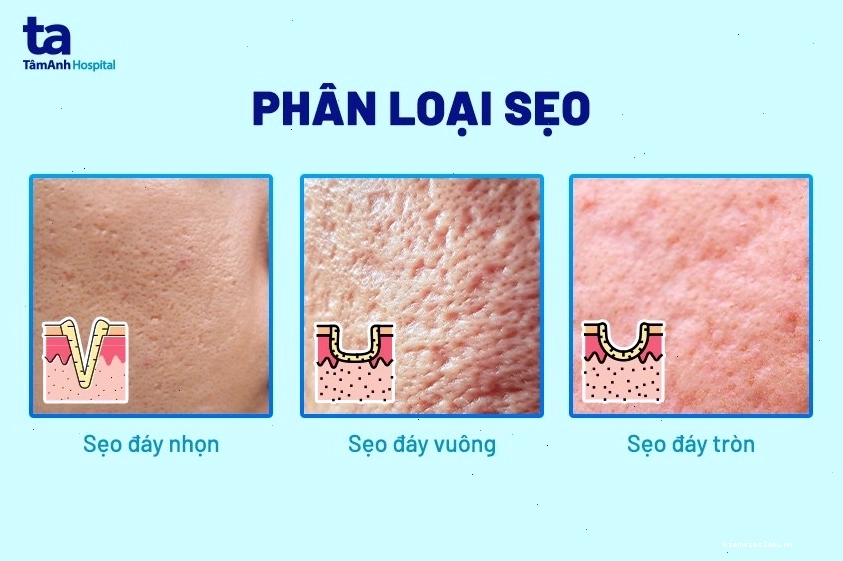 Phân loại các dạng sẹo rỗ trên da mặt phổ biến