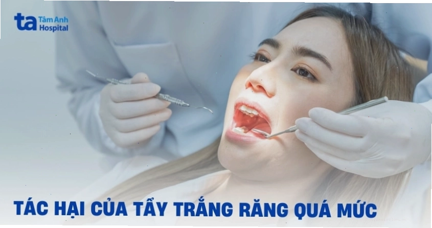 Răng ê buốt sau khi tẩy trắng do hoạt chất làm trắng gây kích ứng tủy răng