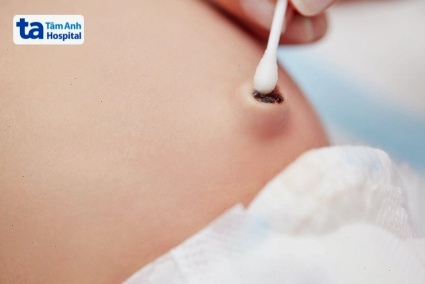 Rốn trẻ sơ sinh ngay sau khi mới rụng cuống rốn