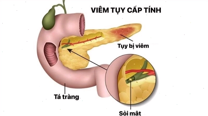 Rượu bia gây hại cho tuyến tụy