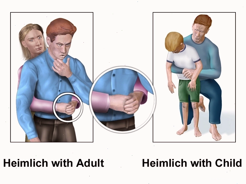 Sơ cứu hóc xương cá bằng cách ép bụng vỗ lưng