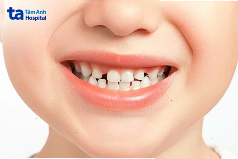 Tầm quan trọng của răng sữa