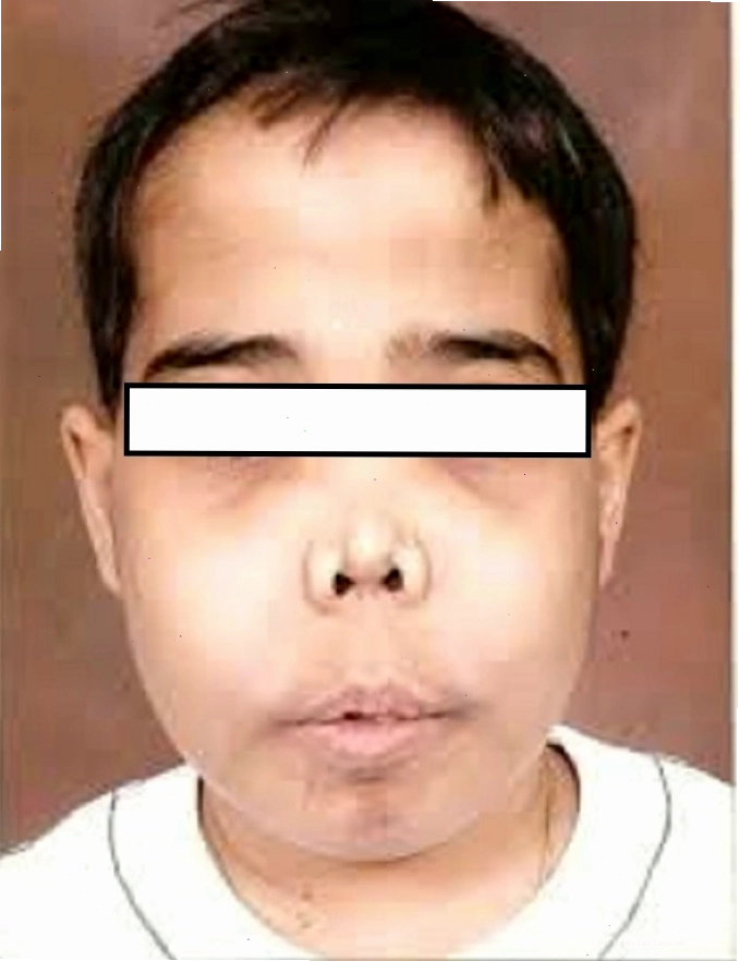 Tầm soát và tư vấn di truyền là biện pháp phòng ngừa tan máu bẩm sinh hiệu quả