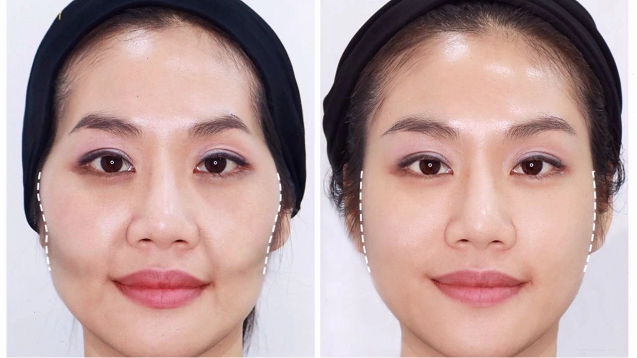 Tập Mewing nâng cao gò má