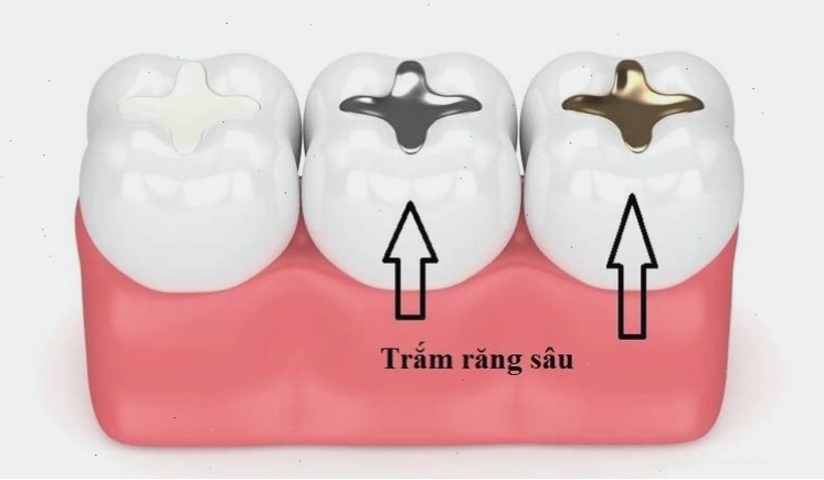 Thời gian duy trì của miếng trám răng phụ thuộc vào chất liệu và cách chăm sóc