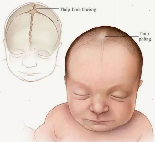 Thóp trẻ sơ sinh bị lõm có thể là dấu hiệu của tình trạng mất nước