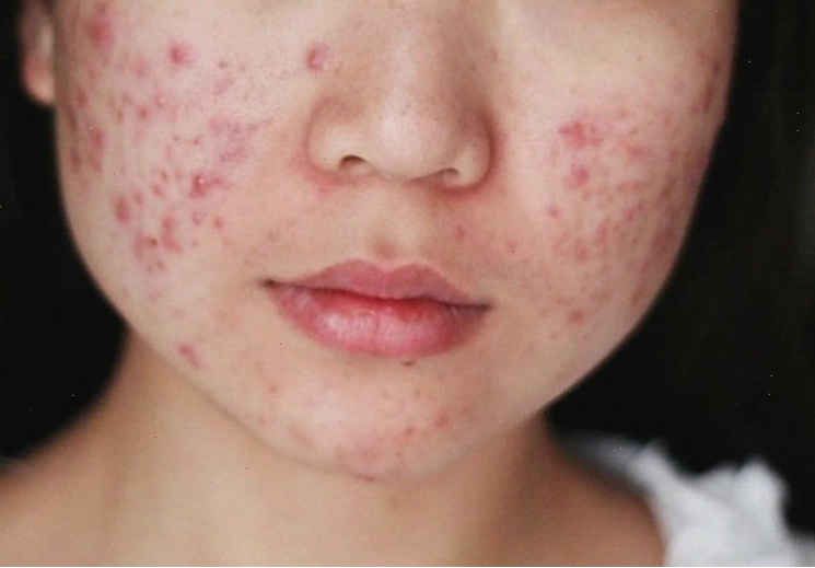 Thức khuya gây nổi mụn trứng cá và làm làn da trở nên xỉn màu, thiếu sức sống