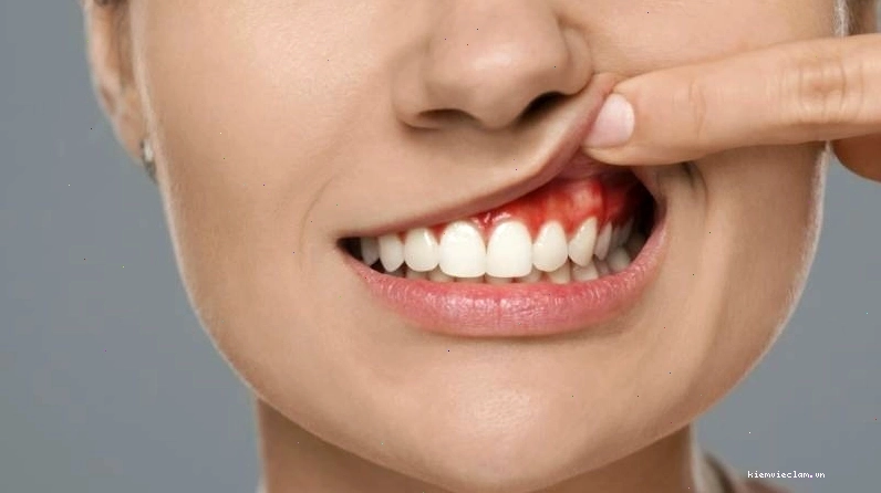 Tình trạng răng miệng khi không lấy cao răng định kỳ