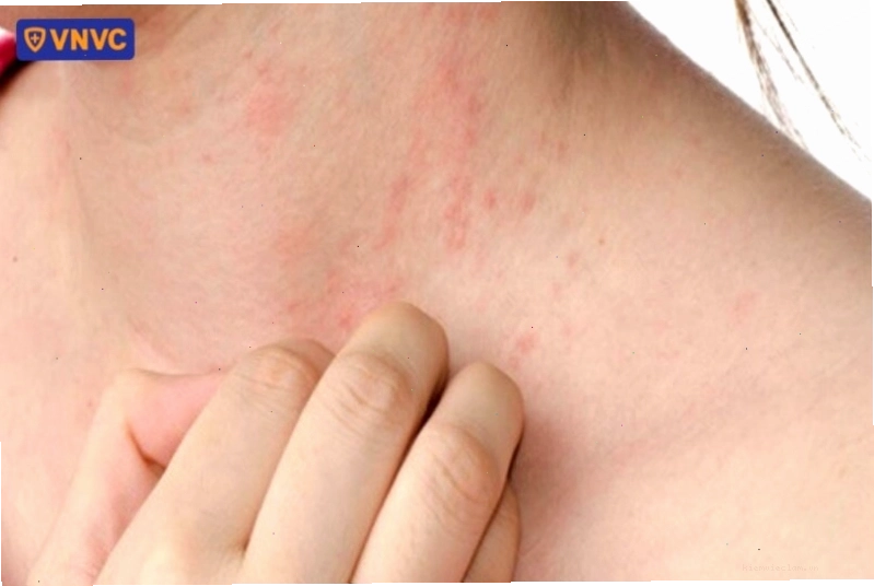 Tình trạng rôm sảy thường gặp ở trẻ em do nóng bức