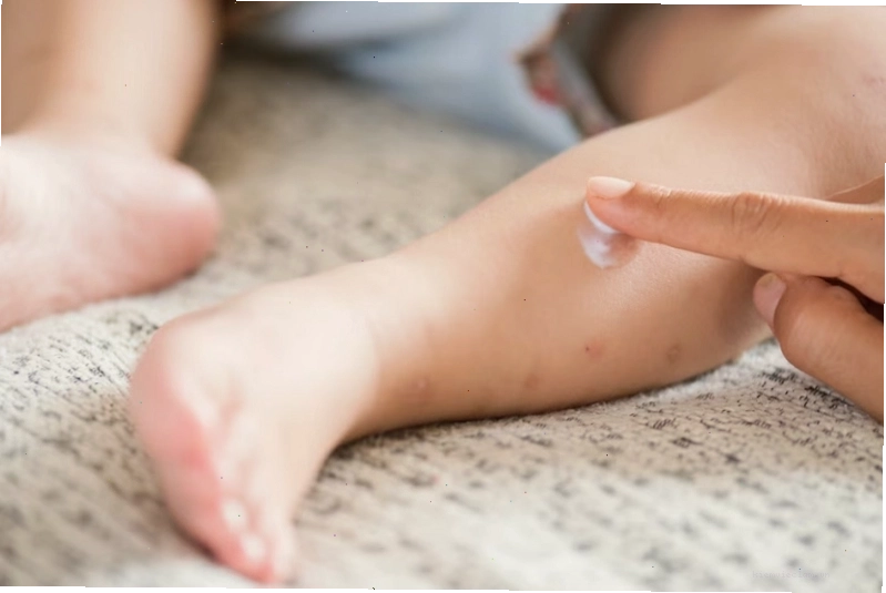 Trẻ nên được dùng kem dưỡng ẩm đúng cách khi bị nổi mề đay