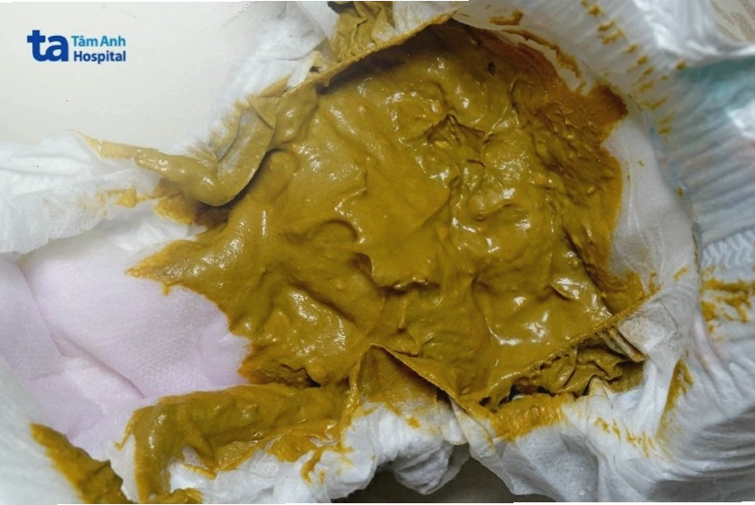 Trẻ sơ sinh đi phân màu xanh lá cây