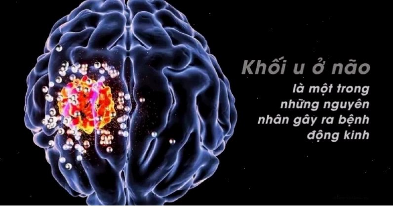U não là một trong những nguyên nhân có thể gây ra bệnh động kinh