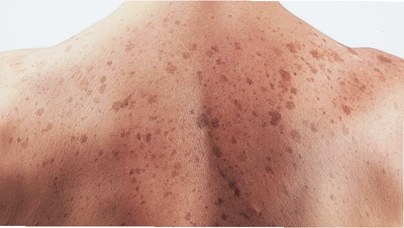 Ung thư tế bào vảy do nồng độ SCC tăng đột biến trong máu