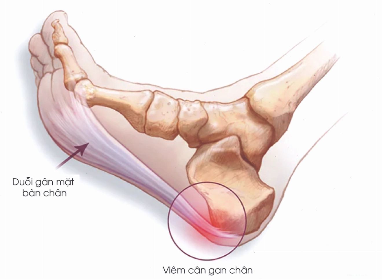Viêm cân gan chân gây đau gót chân