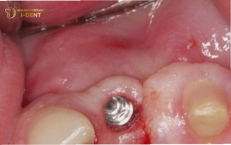 Vùng cấy implant bị nhiễm trùng gây sưng đỏ và khó chịu