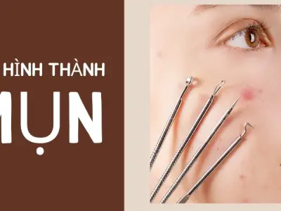 Mụn được hình thành như thế nào? Giải mã quá trình phức tạp trên da