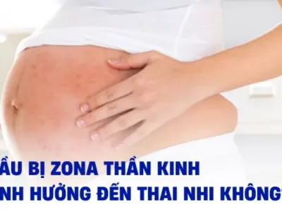 Bầu bị zona có sao không và cách xử lý an toàn