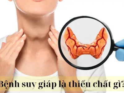 Bệnh suy giáp là thiếu chất gì và cách bổ sung hiệu quả