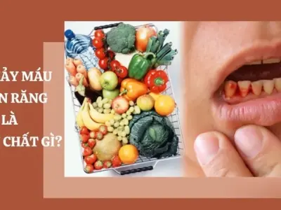 Bị chảy máu chân răng là thiếu chất gì và điều trị ra sao