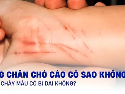 Bị chó cào có sao không và cách xử lý an toàn