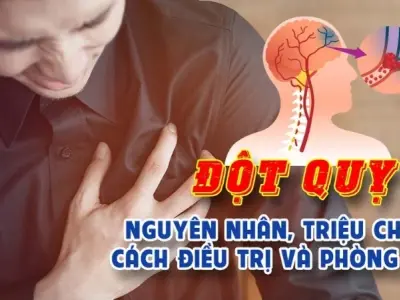 Bị đột quỵ có sao không và cách nhận biết sớm triệu chứng