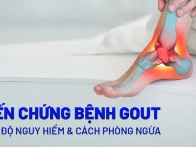 Bị gút có sao không và cách phòng ngừa hiệu quả