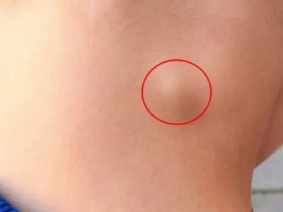 Bị hạch có sao không và khi nào cần đi khám ngay