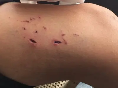 Bị heo cắn có sao không và cách xử lý đúng cách