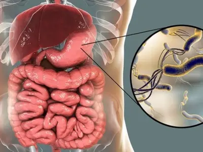 Bị hp có sao không? Dấu hiệu và biến chứng cần biết