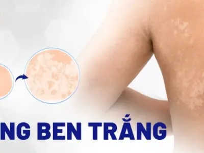 Bị lang ben có sao không và có nên điều trị sớm