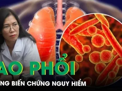 Bị lao phổi có sao không và có chữa khỏi không