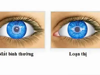 Bị loạn thị có sao không và triệu chứng nhận biết sớm